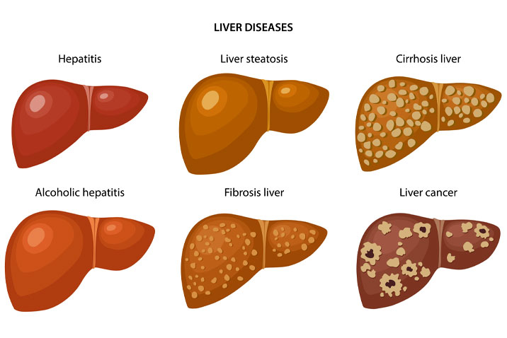 Symptoms Of Liver Cancer In Females 