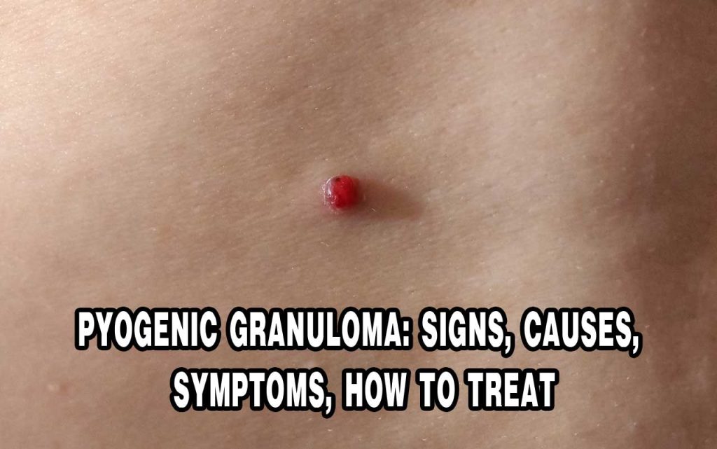 Treatment And Causes Of Pyogenic Granuloma Pt Ben Sehat Sejahtera